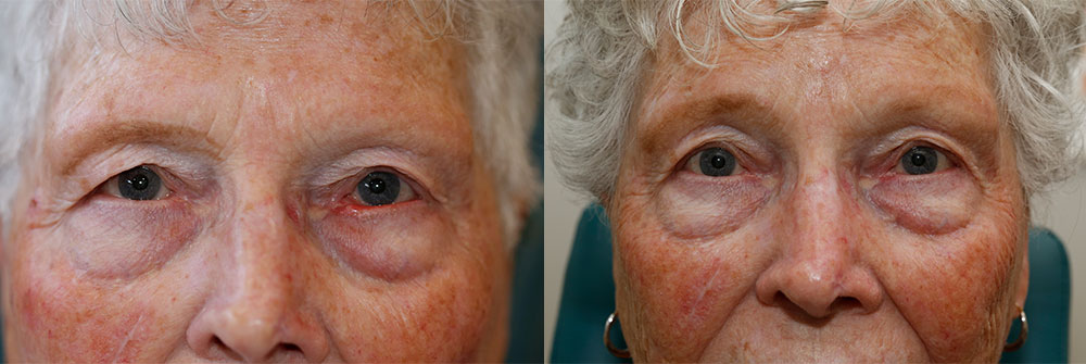 Ectropion Repair Patient 9 | Oasis Eye Face and Skin, Ashland, OR