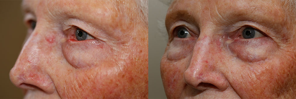 Ectropion Repair Patient 9 | Oasis Eye Face and Skin, Ashland, OR