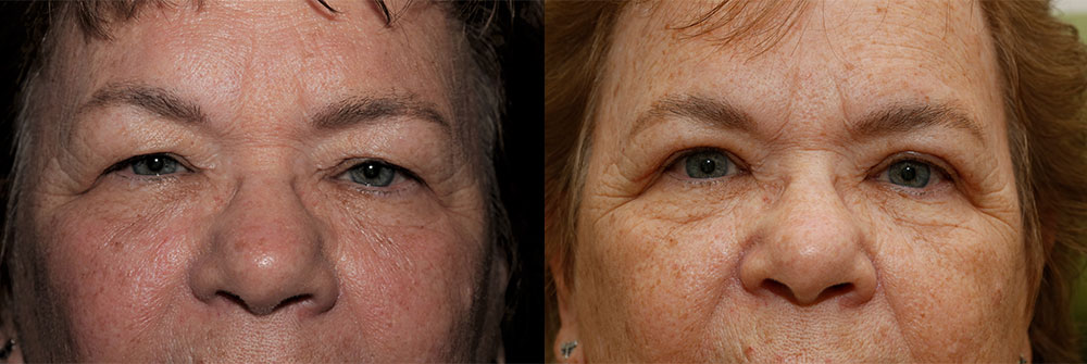 Upper Eyelid Patient 12 | Oasis Eye Face and Skin, Ashland, OR