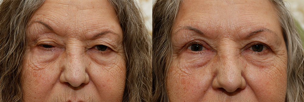 Upper Eyelid and Ptosis Patient 14 | Oasis Eye Face and Skin, Ashland, OR