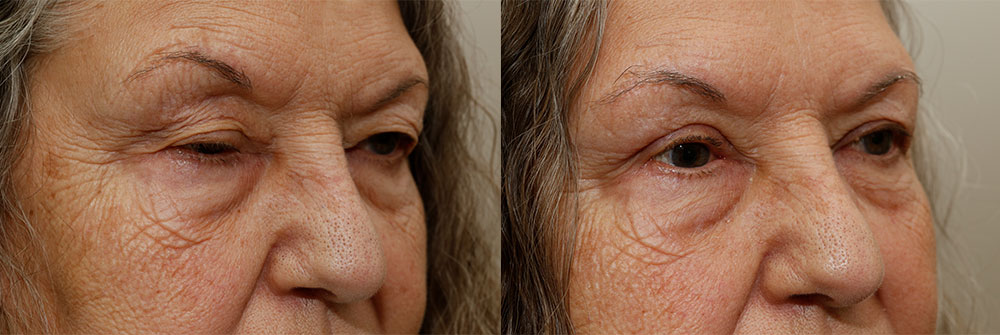 Upper Eyelid and Ptosis Patient 14 | Oasis Eye Face and Skin, Ashland, OR