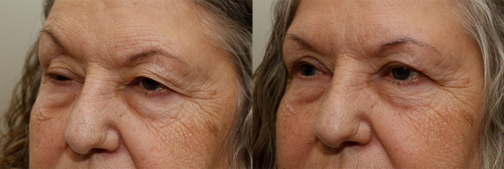 Upper Eyelid and Ptosis Patient 14 | Oasis Eye Face and Skin, Ashland, OR