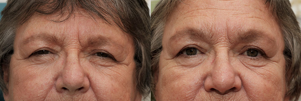 Upper Eyelid, Brow Lift, and Ptosis Patient 15 | Oasis Eye Face and Skin, Ashland, OR