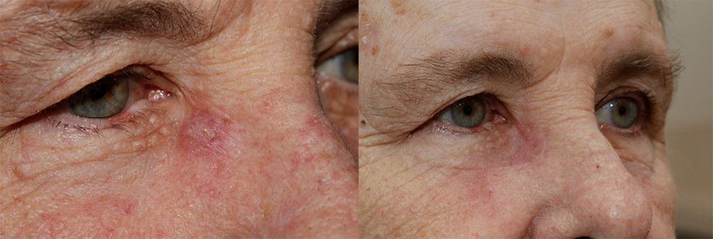 Skin Cancer Patient 16 | Oasis Eye Face and Skin, Ashland, OR