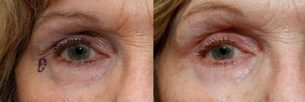 Skin Cancer Patient 18 | Oasis Eye Face and Skin, Ashland, OR