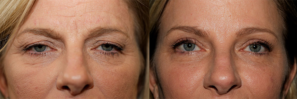 Upper Eyelid and Brow Lift Patient 19 | Oasis Eye Face and Skin, Ashland, OR