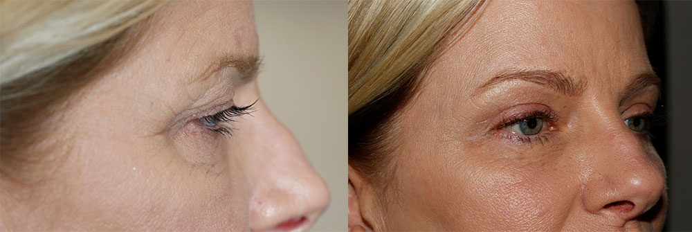 Upper Eyelid and Brow Lift Patient 19 | Oasis Eye Face and Skin, Ashland, OR
