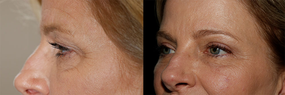 Upper Eyelid and Brow Lift Patient 19 | Oasis Eye Face and Skin, Ashland, OR