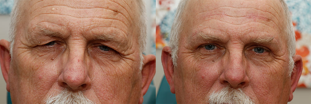 Upper Eyelid Patient 1 | Oasis Eye Face and Skin, Ashland, OR