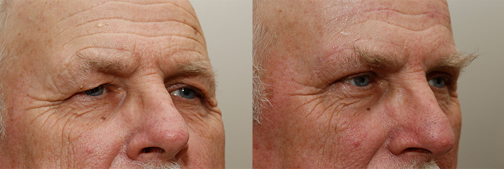 Upper Eyelid Patient 1 | Oasis Eye Face and Skin, Ashland, OR