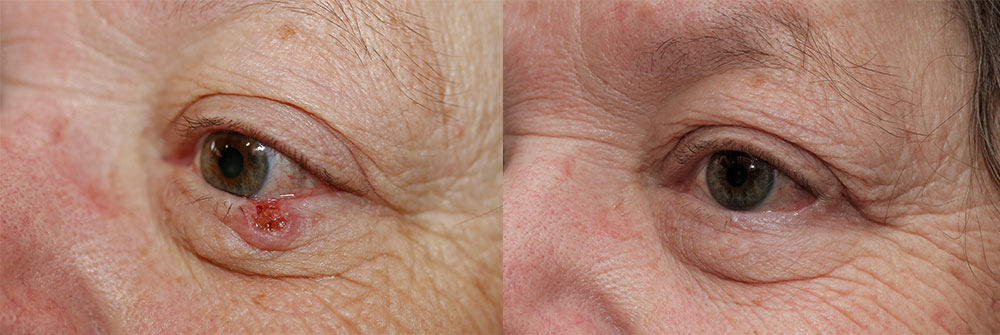 Skin Cancer Patient 20 | Oasis Eye Face and Skin, Ashland, OR