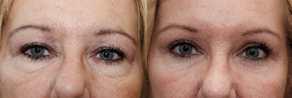 Upper and Lower Eyelids Patient 21 | Oasis Eye Face and Skin, Ashland, OR