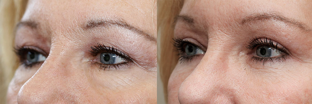 Upper and Lower Eyelids Patient 21 | Oasis Eye Face and Skin, Ashland, OR