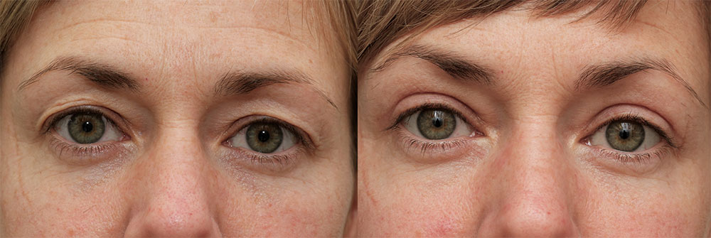 Upper Eyelids Patient 22 | Oasis Eye Face and Skin, Ashland, OR