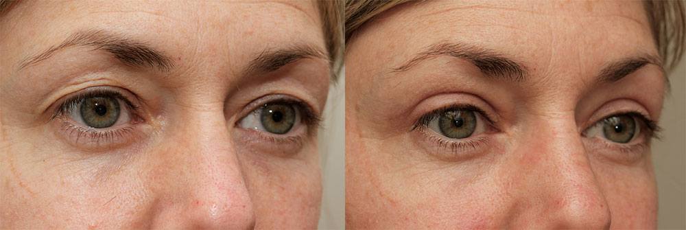 Upper Eyelids Patient 22 | Oasis Eye Face and Skin, Ashland, OR