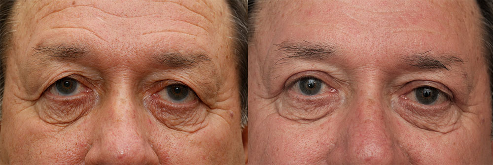 Upper Eyelids Patient 23 | Oasis Eye Face and Skin, Ashland, OR