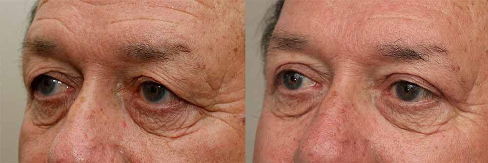 Upper Eyelids Patient 23 | Oasis Eye Face and Skin, Ashland, OR