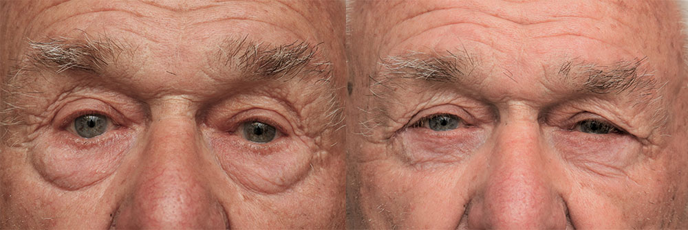 Lower Eyelids Patient 24 | Oasis Eye Face and Skin, Ashland, OR