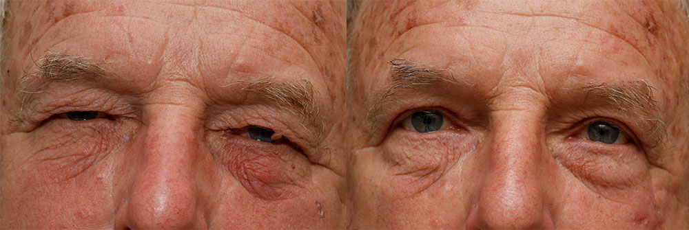 Upper Eyelids Patient 25 | Oasis Eye Face and Skin, Ashland, OR