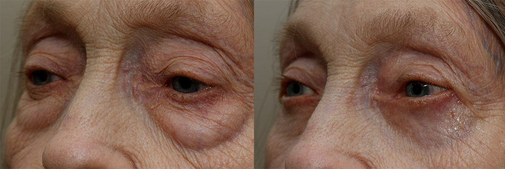 Lower Eyelids Patient 26 | Oasis Eye Face and Skin, Ashland, OR