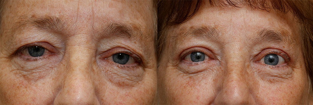 Upper Eyelids Patient 27 | Oasis Eye Face and Skin, Ashland, OR