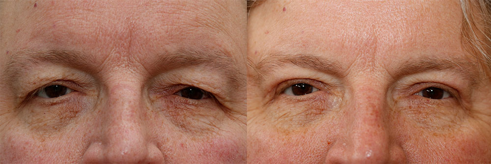 Upper Eyelids Patient 28 | Oasis Eye Face and Skin, Ashland, OR