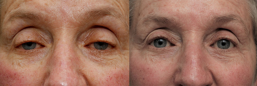 Ptosis Repair Eyelids Patient 29 | Oasis Eye Face and Skin, Ashland, OR