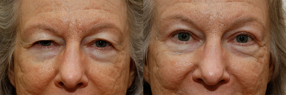 Upper Eyelid Patient 2 | Oasis Eye Face and Skin, Ashland, OR