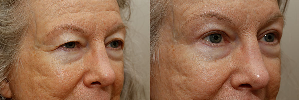 Upper Eyelid Patient 2 | Oasis Eye Face and Skin, Ashland, OR