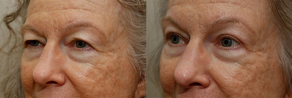 Upper Eyelid Patient 2 | Oasis Eye Face and Skin, Ashland, OR
