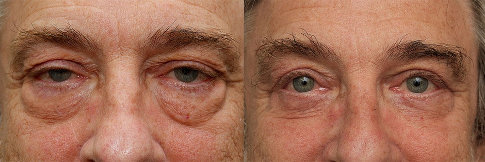 Upper, Lower Ptosis Repair Eyelids Patient 29 | Oasis Eye Face and Skin, Ashland, OR