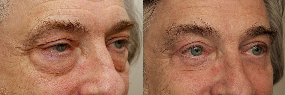 Upper, Lower Ptosis Repair Eyelids Patient 29 | Oasis Eye Face and Skin, Ashland, OR