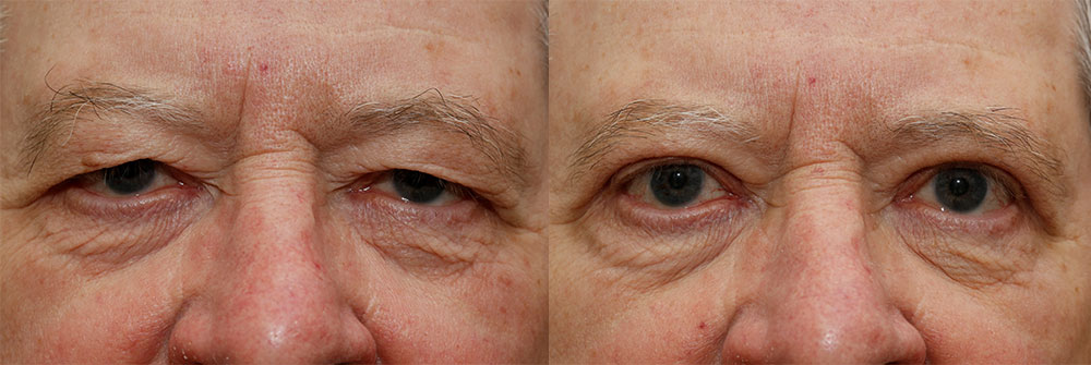 Lower Eyelids Patient 26 | Oasis Eye Face and Skin, Ashland, OR