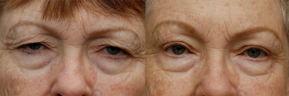 Upper Eyelids Patient 32 | Oasis Eye Face and Skin, Ashland, OR