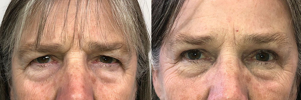 Upper Eyelid and Brow Lift Patient 33 | Oasis Eye Face and Skin, Ashland, OR