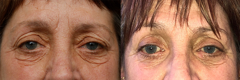 Upper and Lower Eyelid Patient 34 | Oasis Eye Face and Skin, Ashland, OR