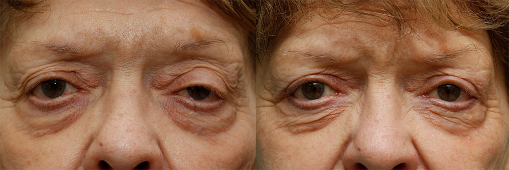 Upper Eyelid (Blepharoplasty) and Ptosis Repair