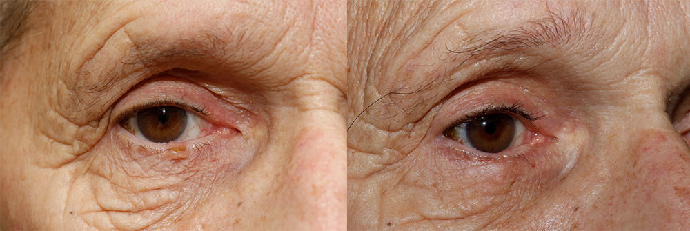 Skin Cancer Patient 36 | Oasis Eye Face and Skin, Ashland, OR