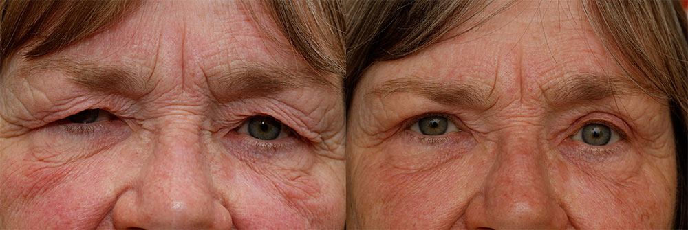 Upper Eyelids Patient 37 | Oasis Eye Face and Skin, Ashland, OR