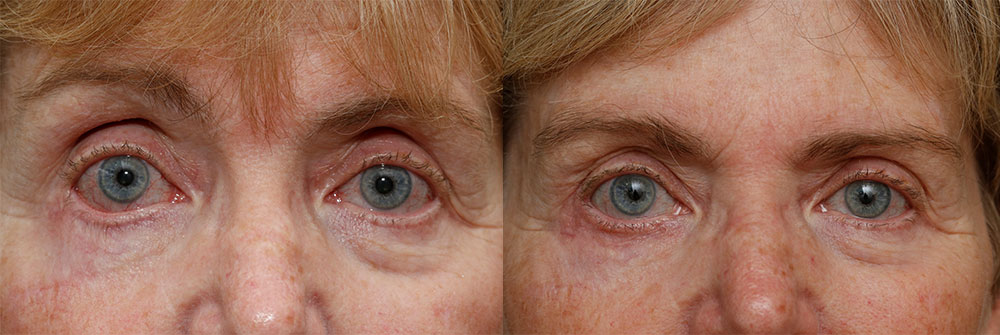 Retraction Repair Patient 38 | Oasis Eye Face and Skin, Ashland, OR