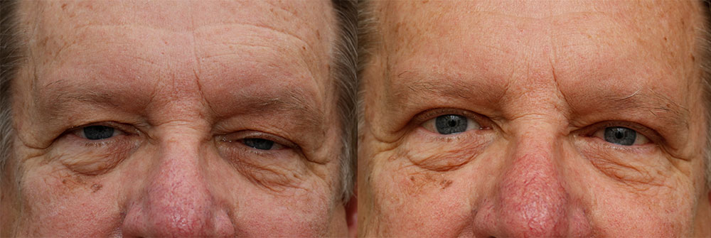 Upper Eyelid and Ptosis Patient 39 | Oasis Eye Face and Skin, Ashland, OR