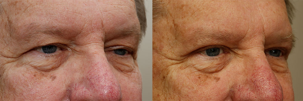 Upper Eyelid and Ptosis Patient 39 | Oasis Eye Face and Skin, Ashland, OR