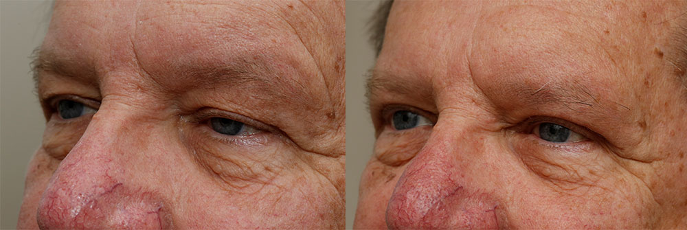Upper Eyelid and Ptosis Patient 39 | Oasis Eye Face and Skin, Ashland, OR