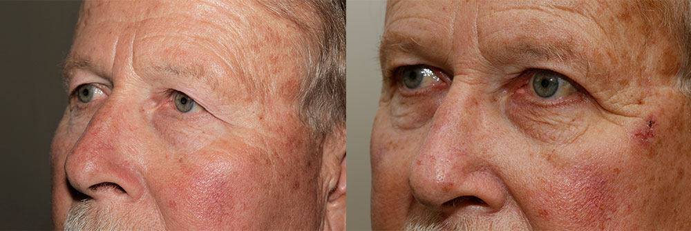 Upper Eyelid Patient 3 | Oasis Eye Face and Skin, Ashland, OR