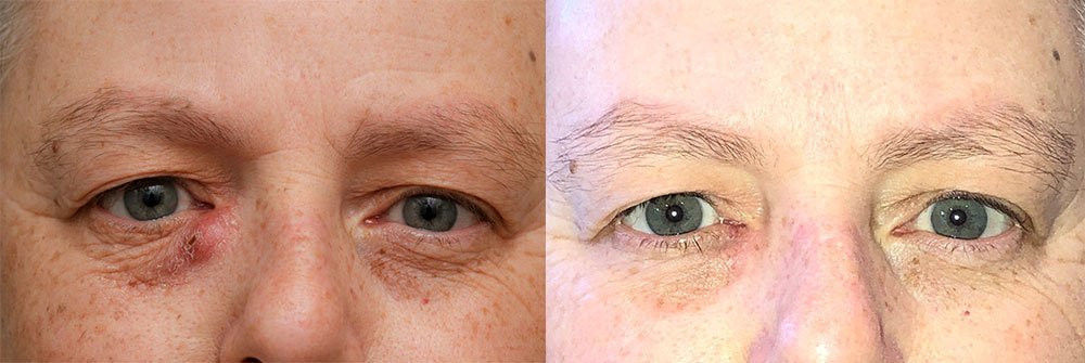 Tear Drain Repair Patient 46 | Oasis Eye Face and Skin, Ashland, OR