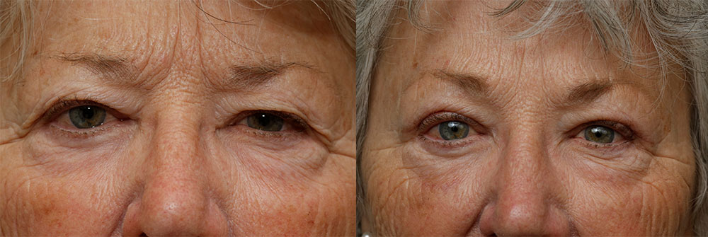 Upper Eyelid and Brow Lift Patient 47 | Oasis Eye Face and Skin, Ashland, OR