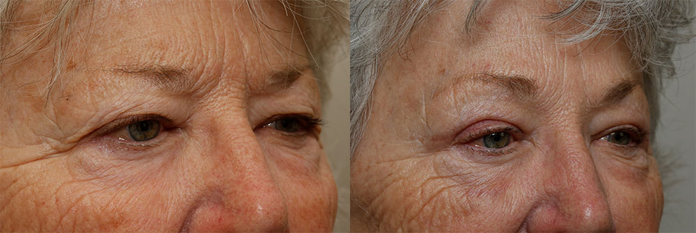 Upper Eyelid and Brow Lift Patient 47 | Oasis Eye Face and Skin, Ashland, OR