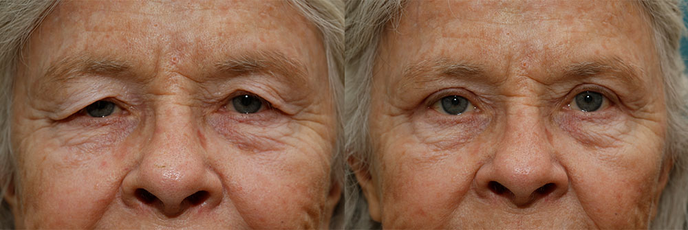 Upper Eyelid Patient 4 | Oasis Eye Face and Skin, Ashland, OR