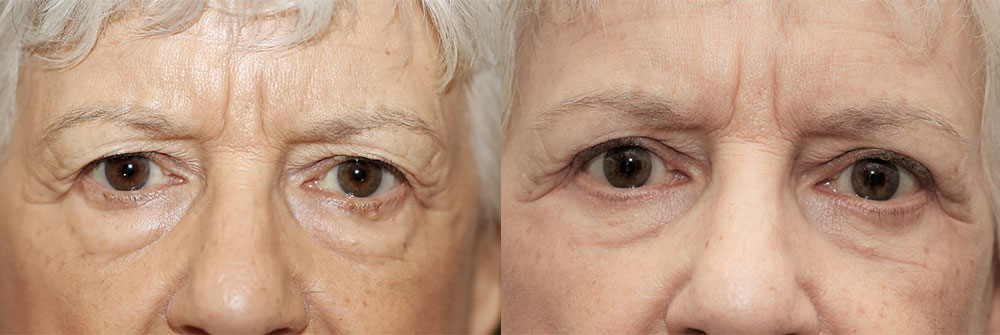 Upper Eyelid Patient 6 | Oasis Eye Face and Skin, Ashland, OR