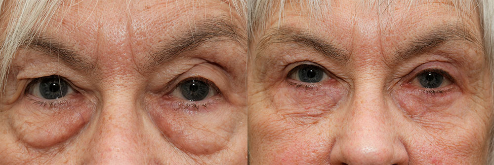 Upper Eyelid Patient 7 | Oasis Eye Face and Skin, Ashland, OR